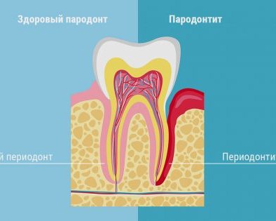 Что нужно знать о периодонтите тем, у кого есть зубы