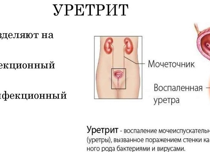 Как лечить инфекции мочевыводящих путей