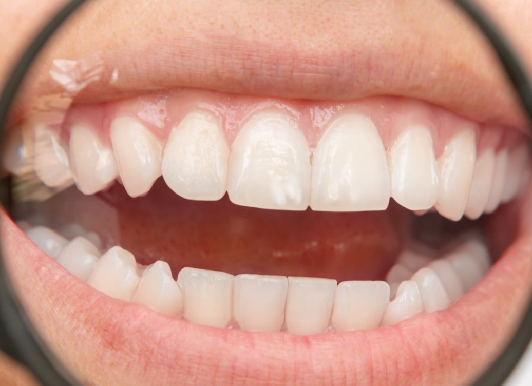 Белые пятна на зубах: почему появляются и как убрать