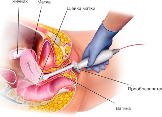Зачем делать УЗИ органов малого таза и как к нему подготовиться